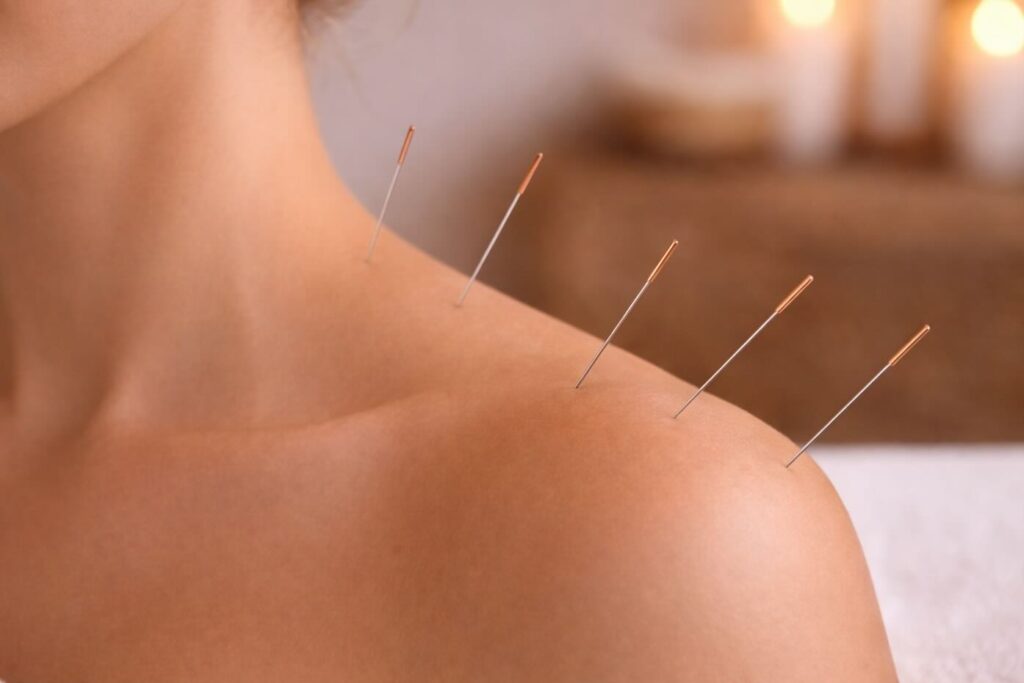 Does acupuncture work for neck and shoulder pain? Close-up of acupuncture needles placed in the upper trapezius.
