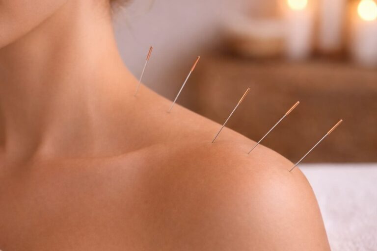 Does acupuncture work for neck and shoulder pain? Close-up of acupuncture needles placed in the upper trapezius.